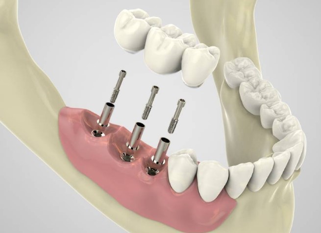 Лазерная имплантация зубов: как проходит процедура и кому подходит